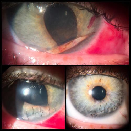 Penetrating trauma of the cornea (2)